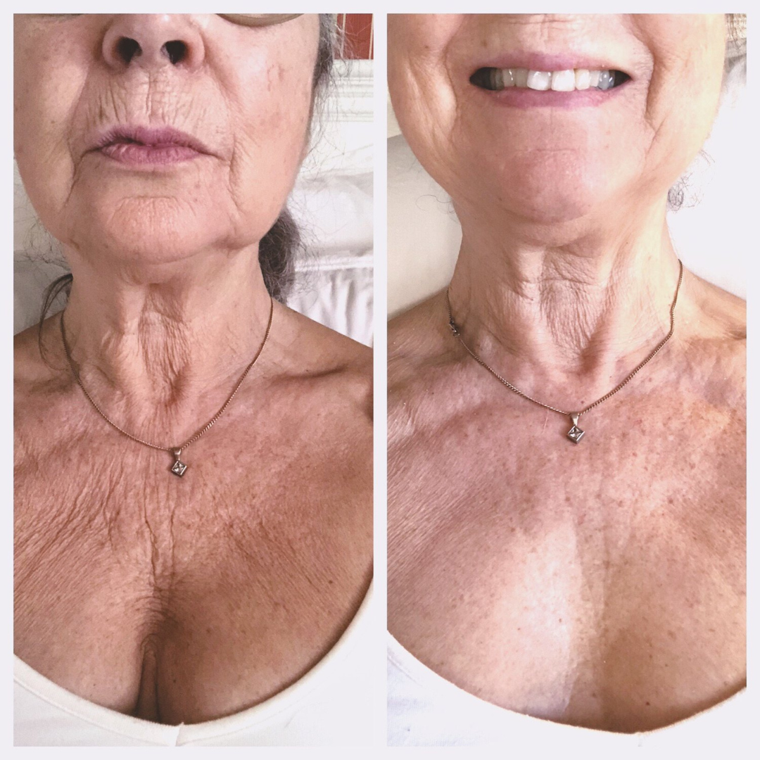 Neck Wrinkles Patch